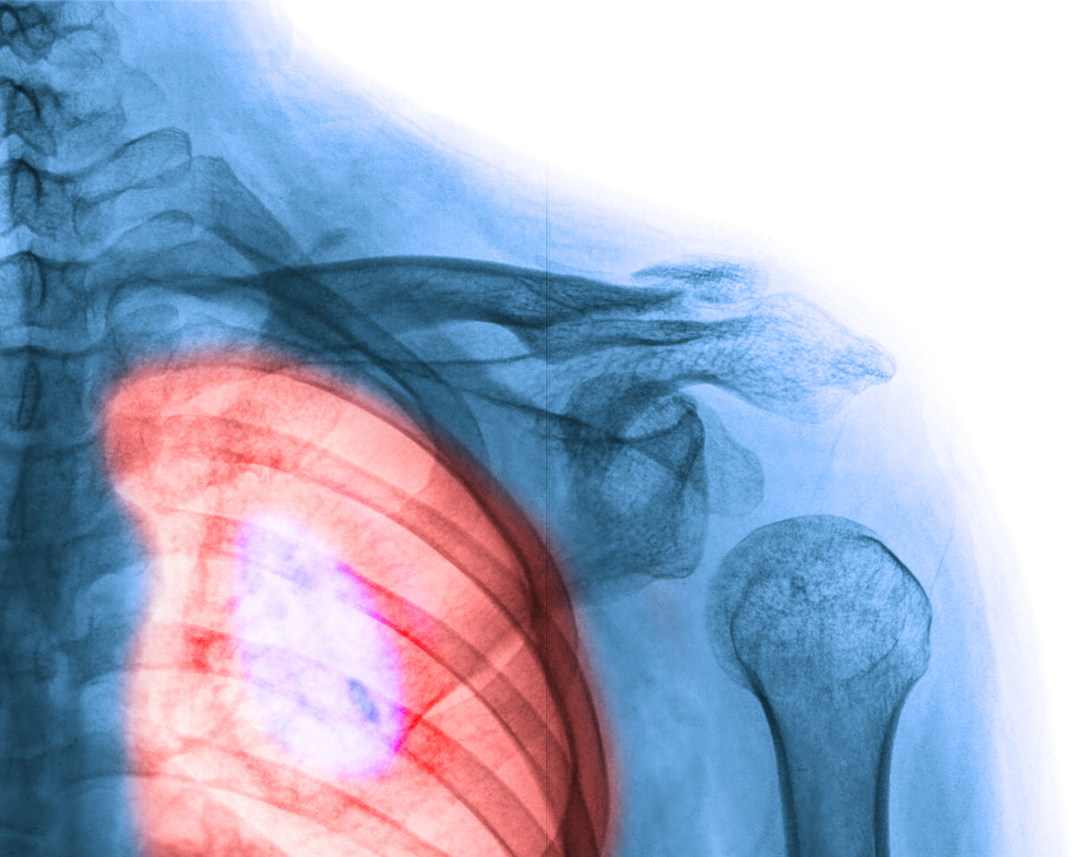 Overall Survival High for Group of Stage IV NSCLC Patients Overall Survival High for Group of Stage IV NSCLC Patients